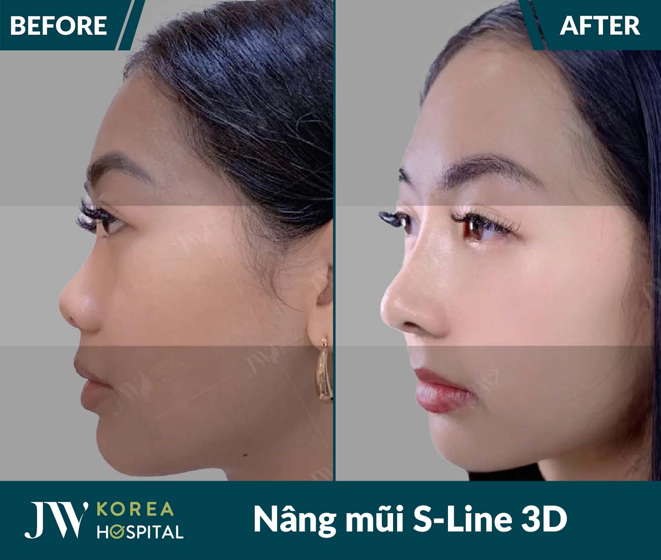 Nâng mũi S Line 3D