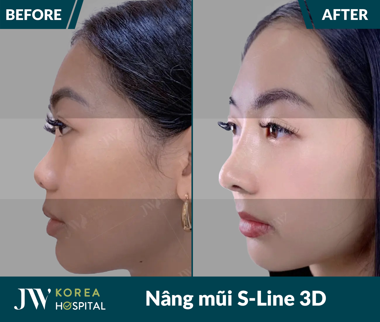 Nâng mũi S Line 3D