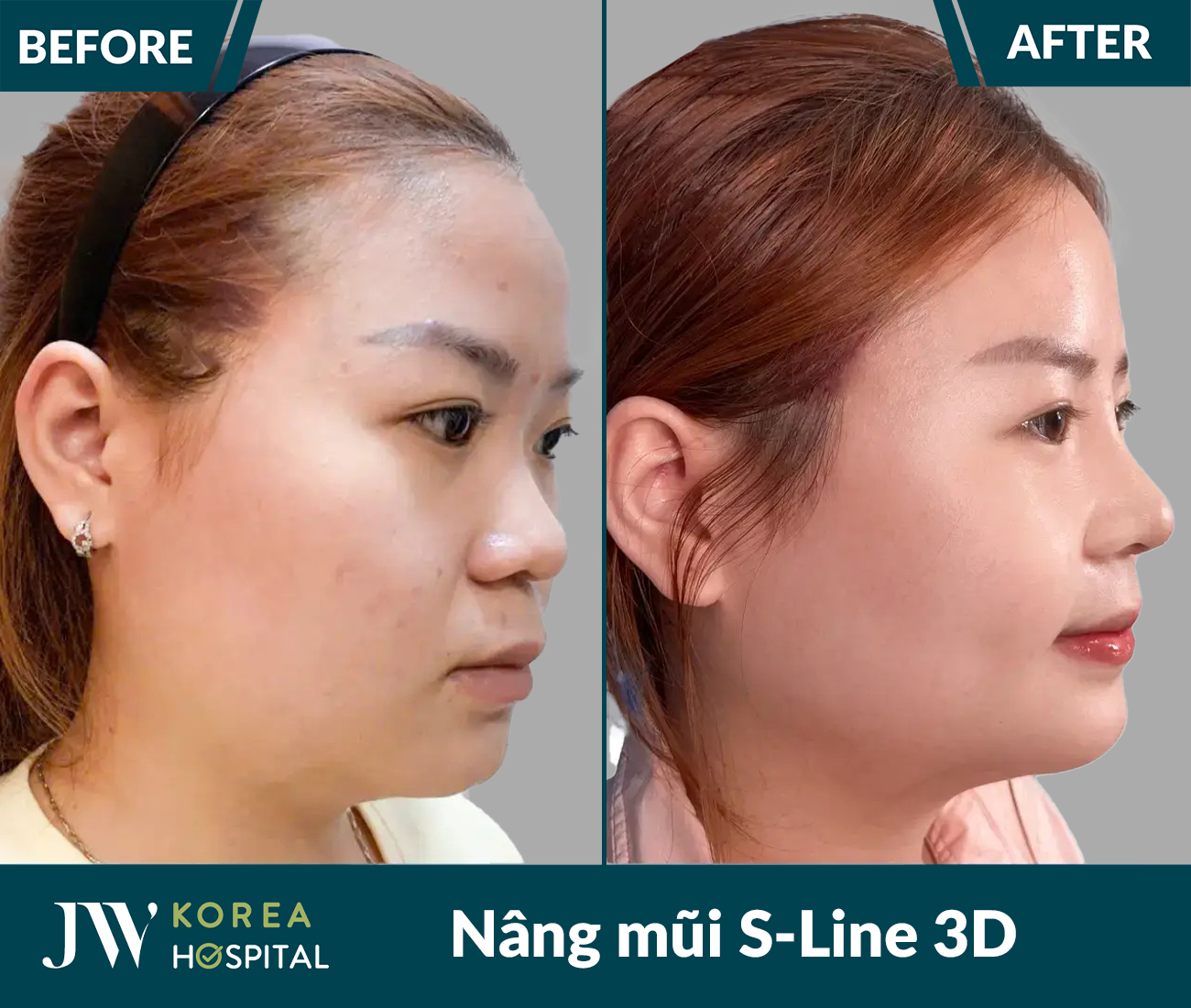 Nâng mũi S Line 3D