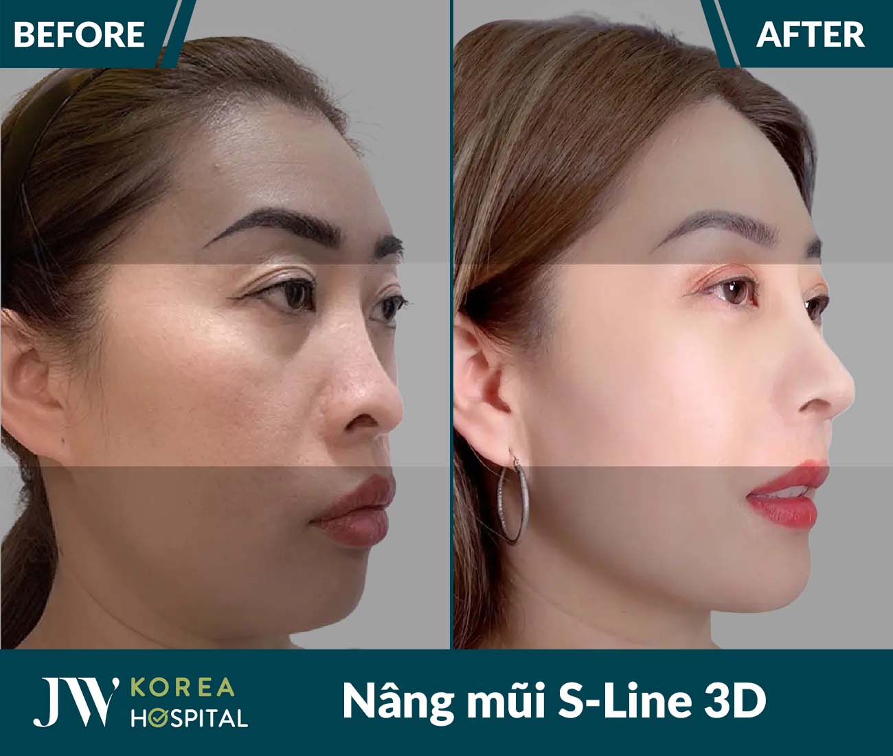 Nâng mũi S Line 3D
