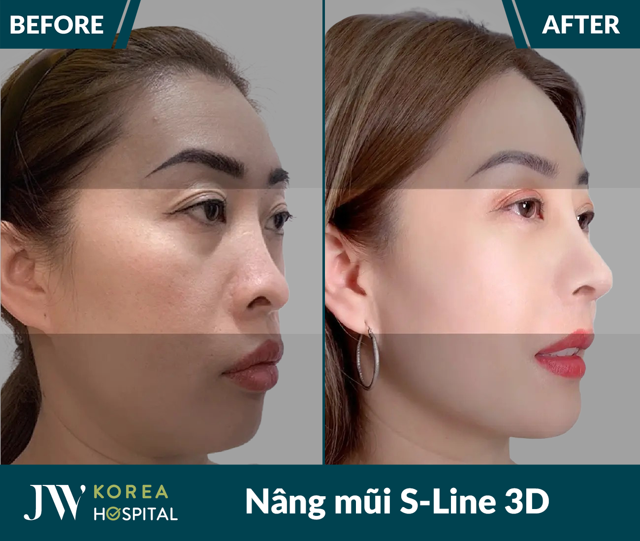 Nâng mũi S Line 3D