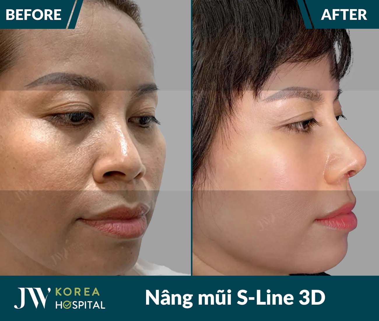 Nâng mũi S Line 3D