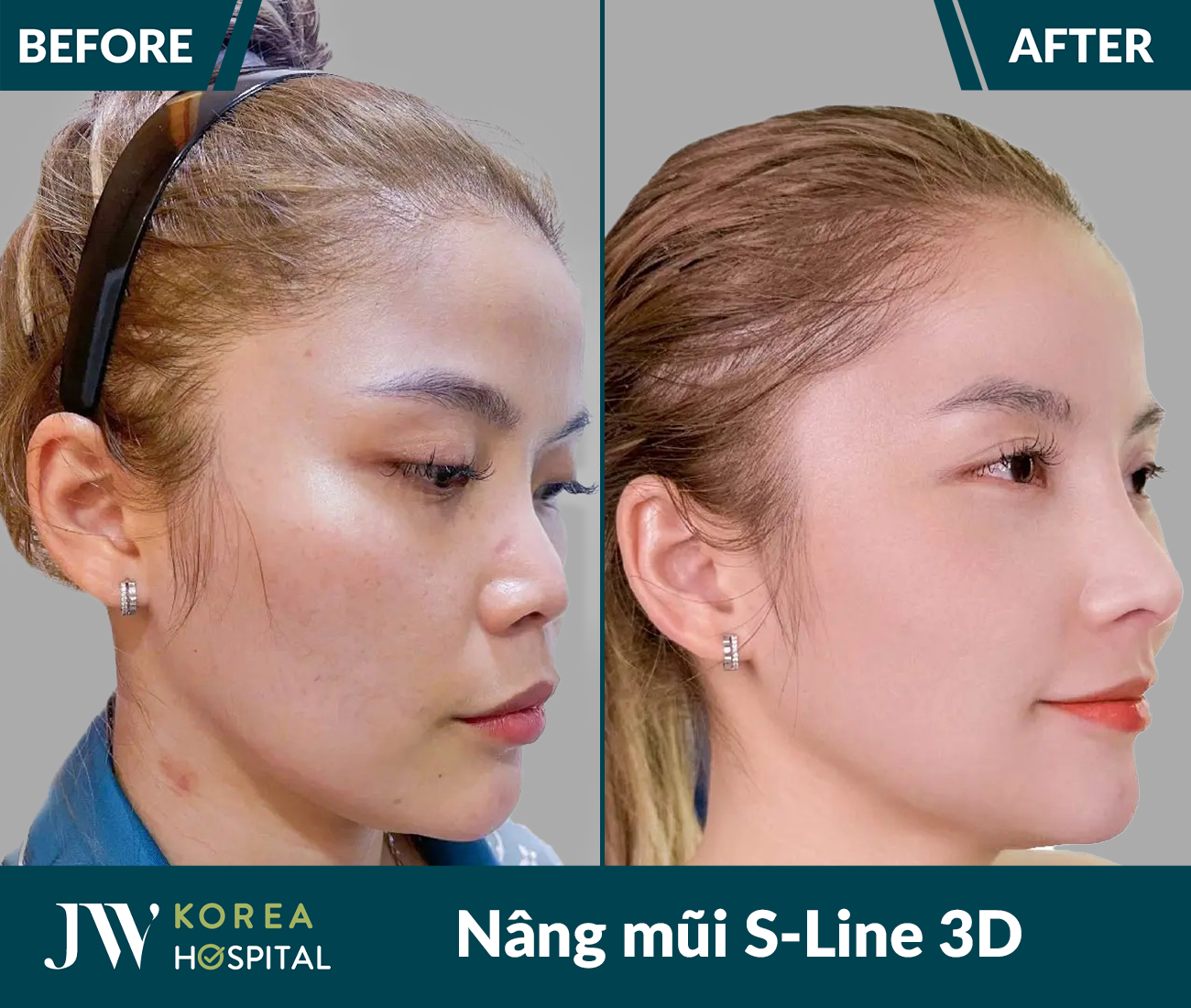 Nâng mũi S Line 3D