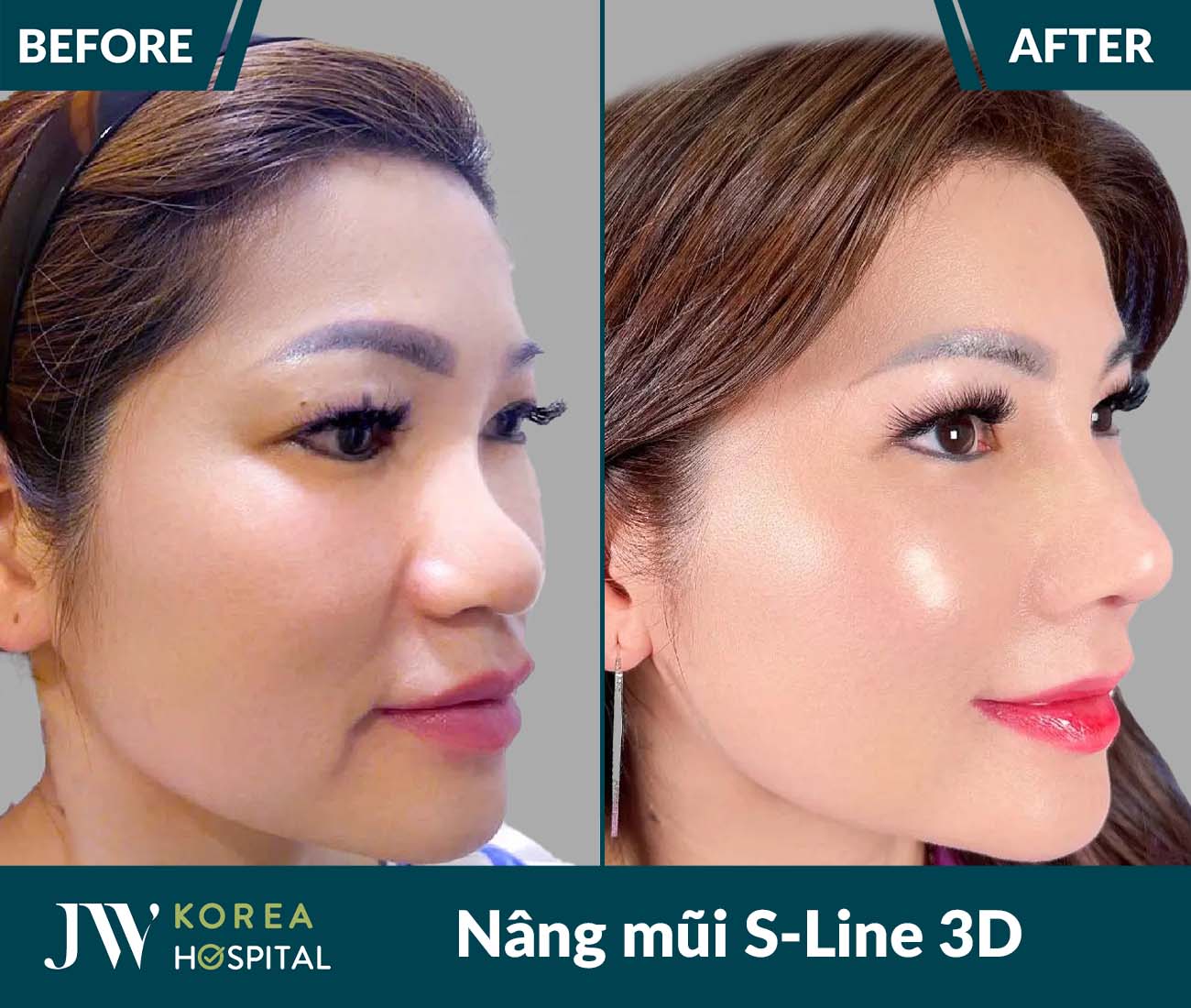 Nâng mũi S Line 3D