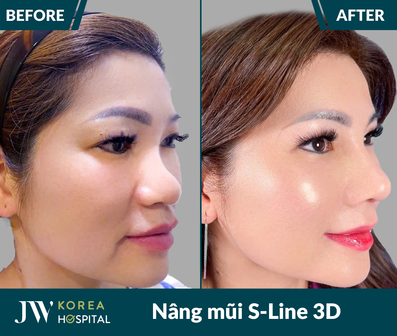 Nâng mũi S Line 3D
