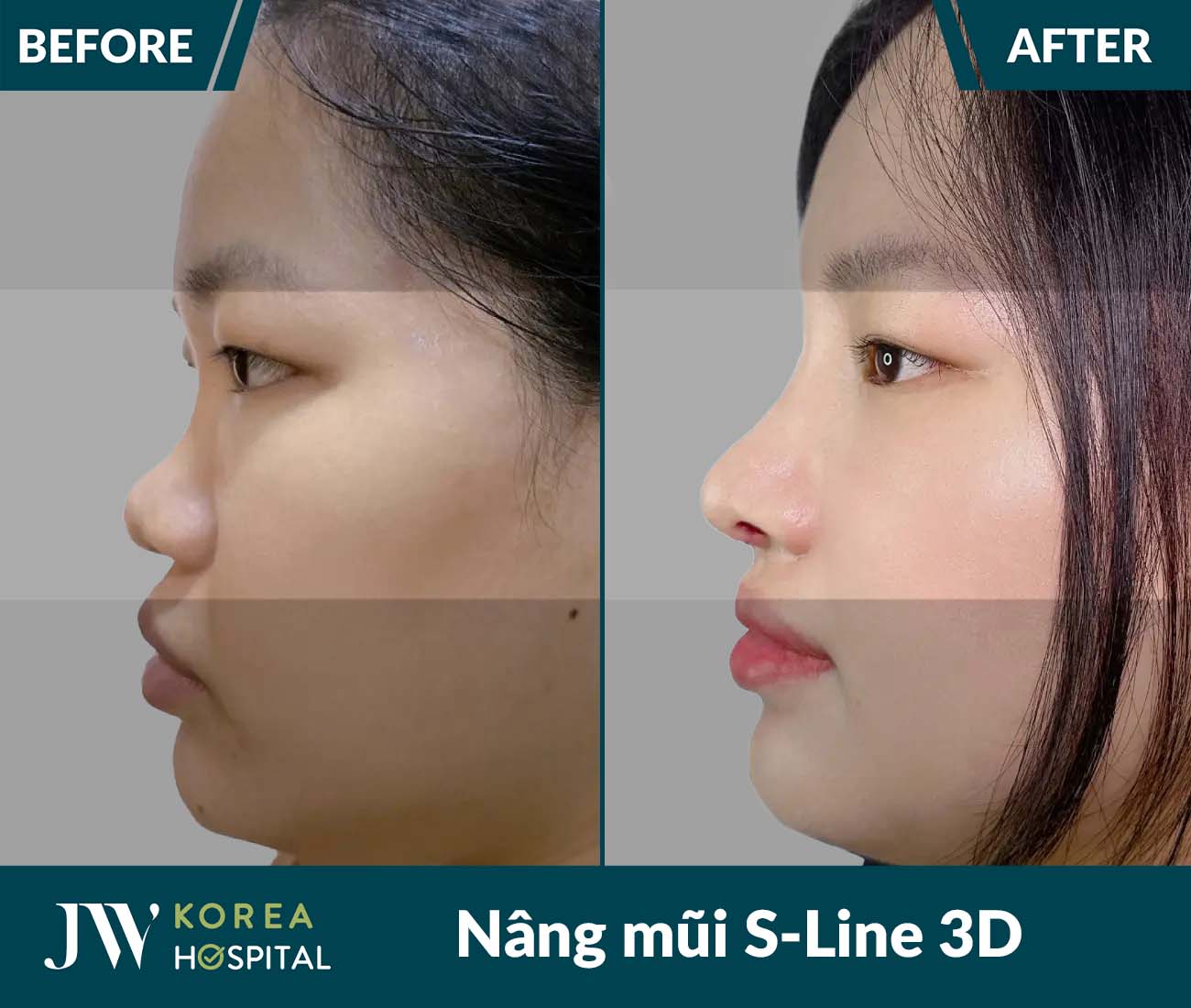 Nâng mũi S Line 3D