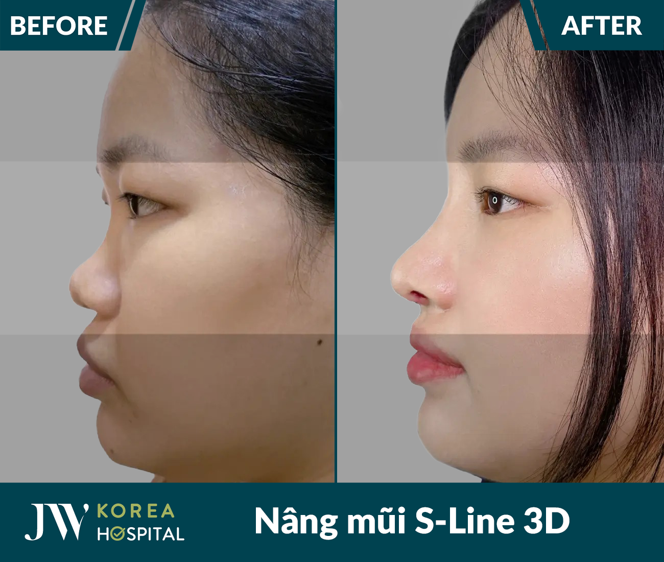 Nâng mũi S Line 3D