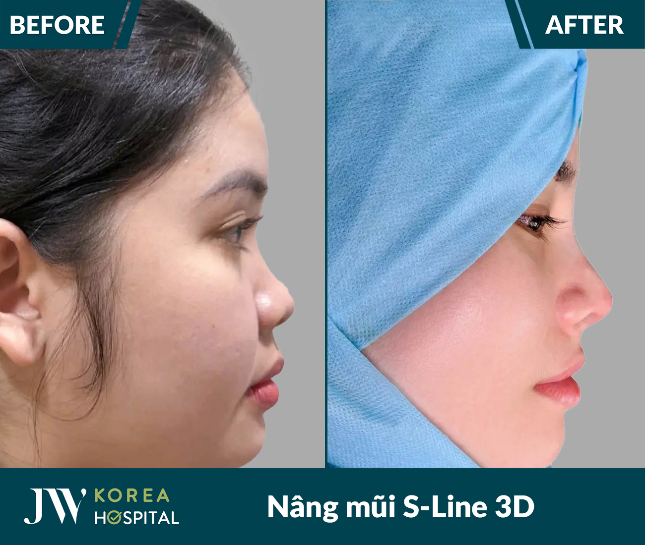 Nâng mũi S Line 3D