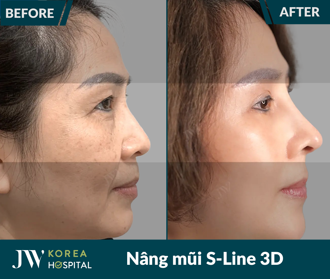 Nâng mũi S Line 3D