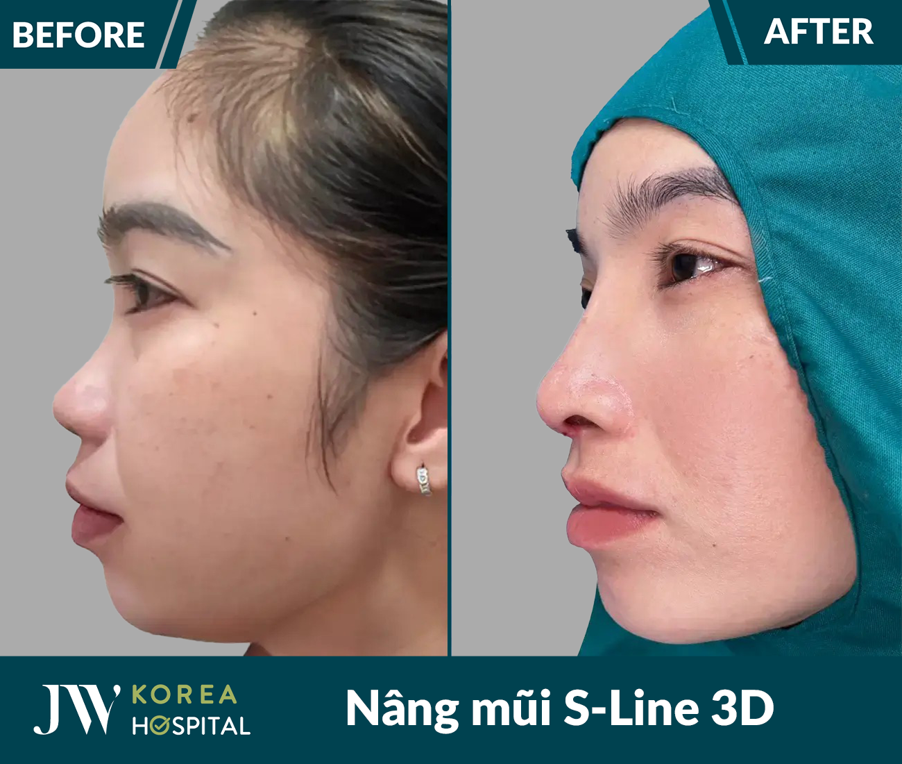 Nâng mũi S Line 3D