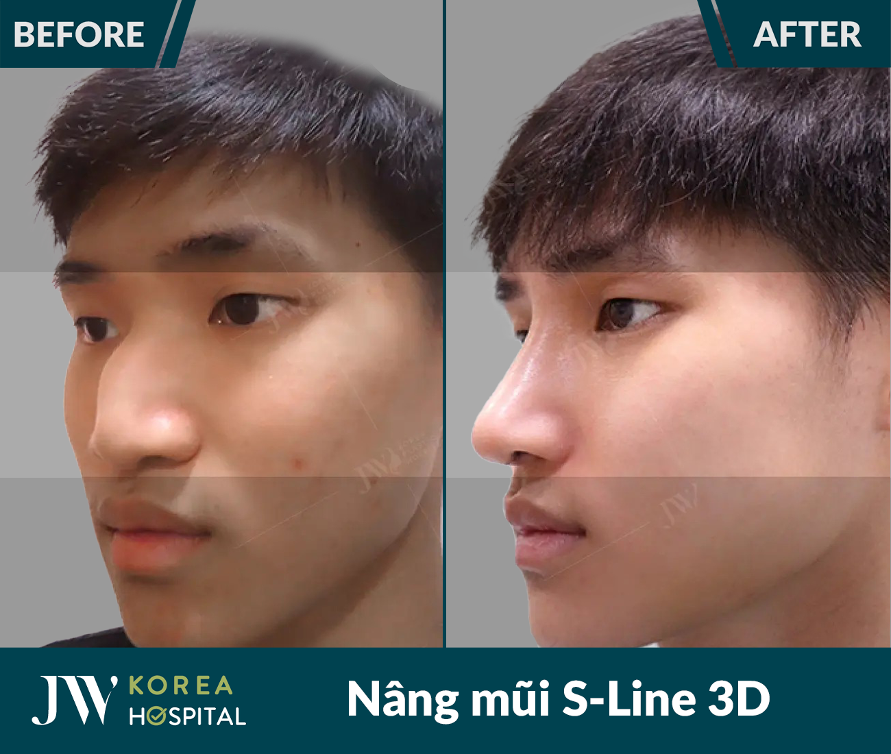 Nâng mũi S Line 3D