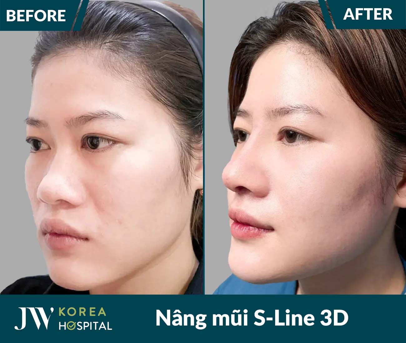 Nâng mũi S Line 3D