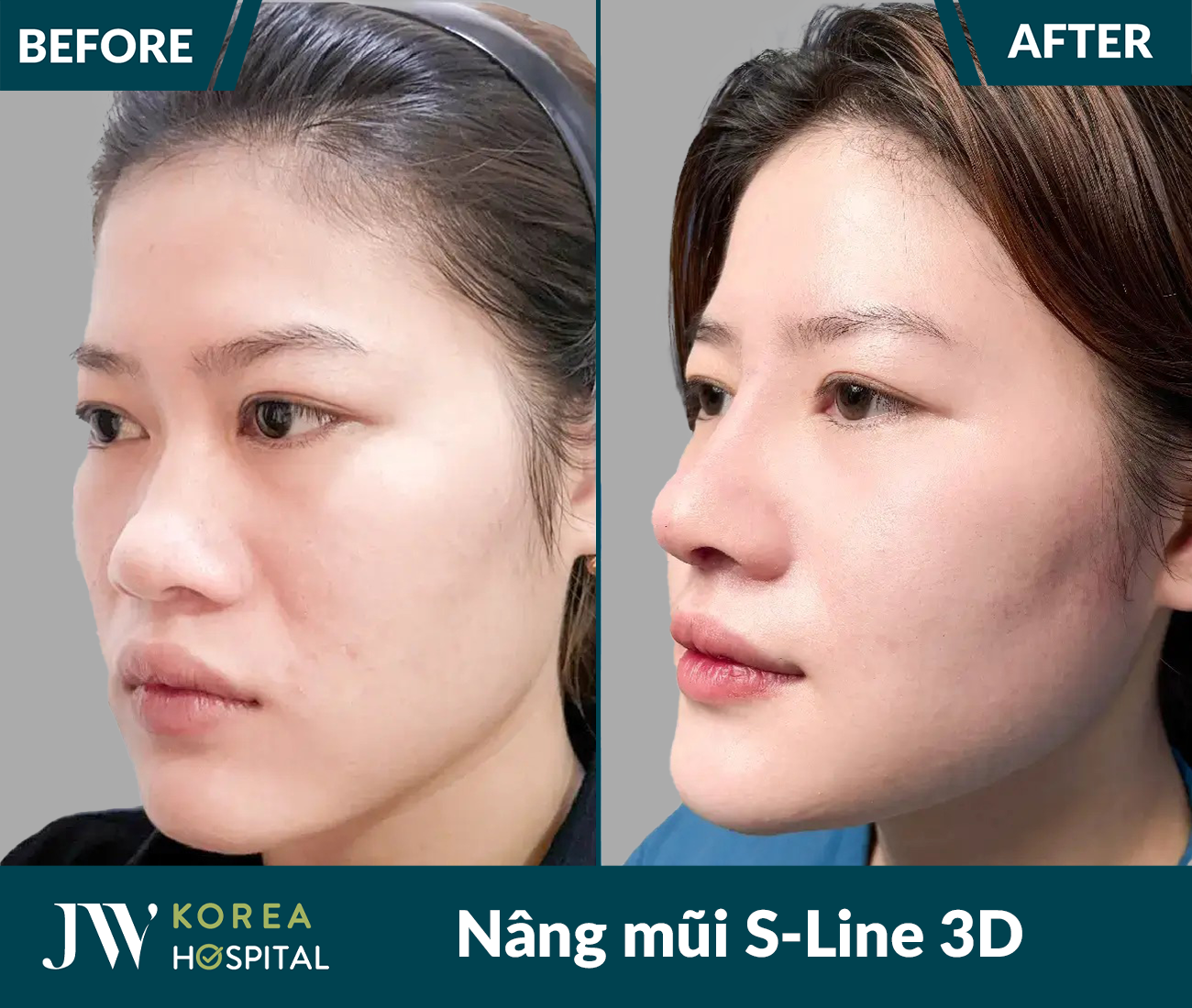 Nâng mũi S Line 3D