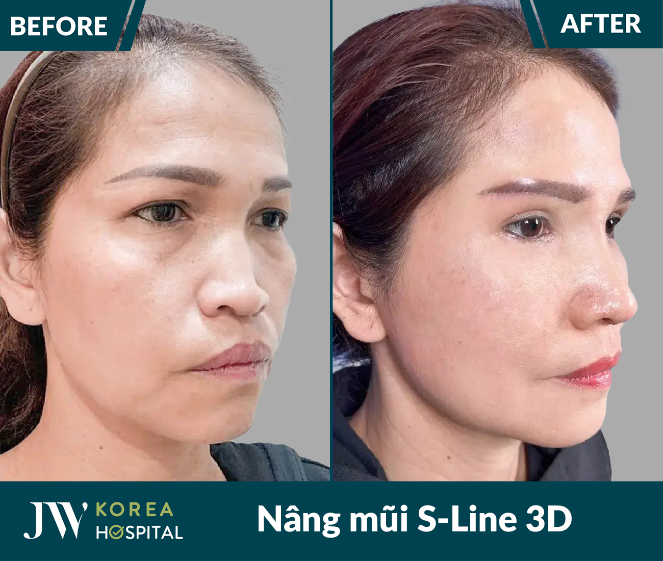 Nâng mũi S Line 3D