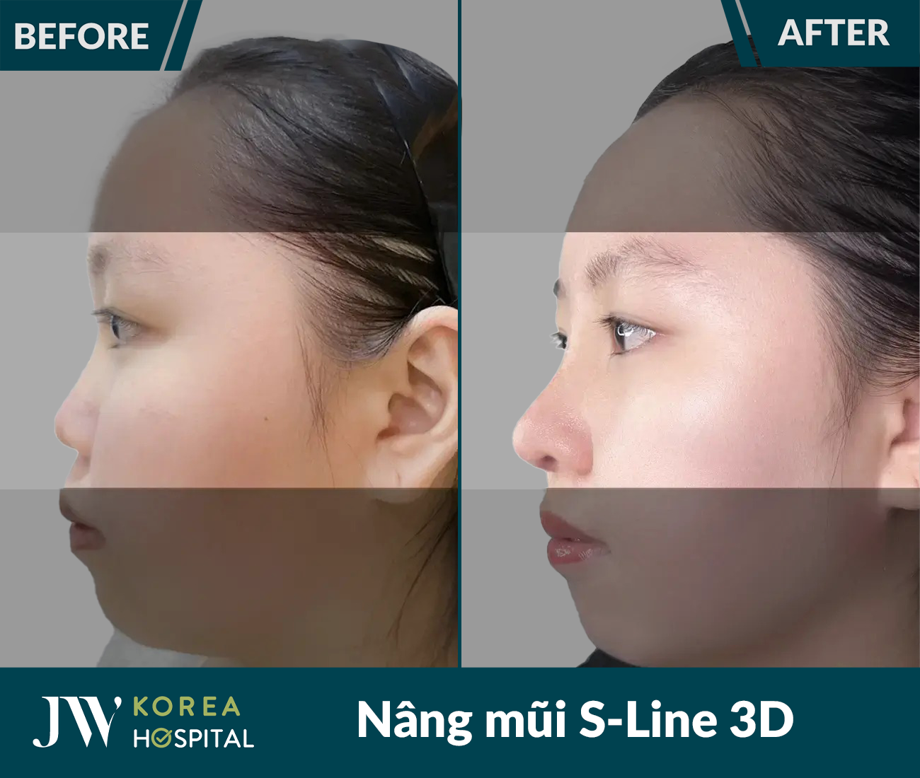 Nâng mũi S Line 3D