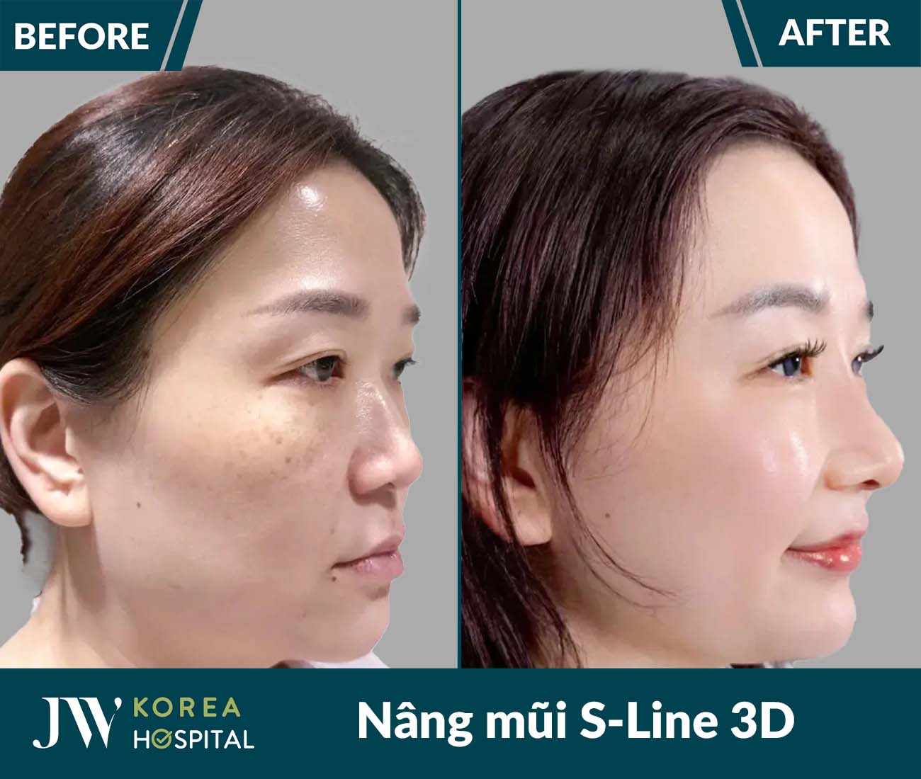 Nâng mũi S Line 3D