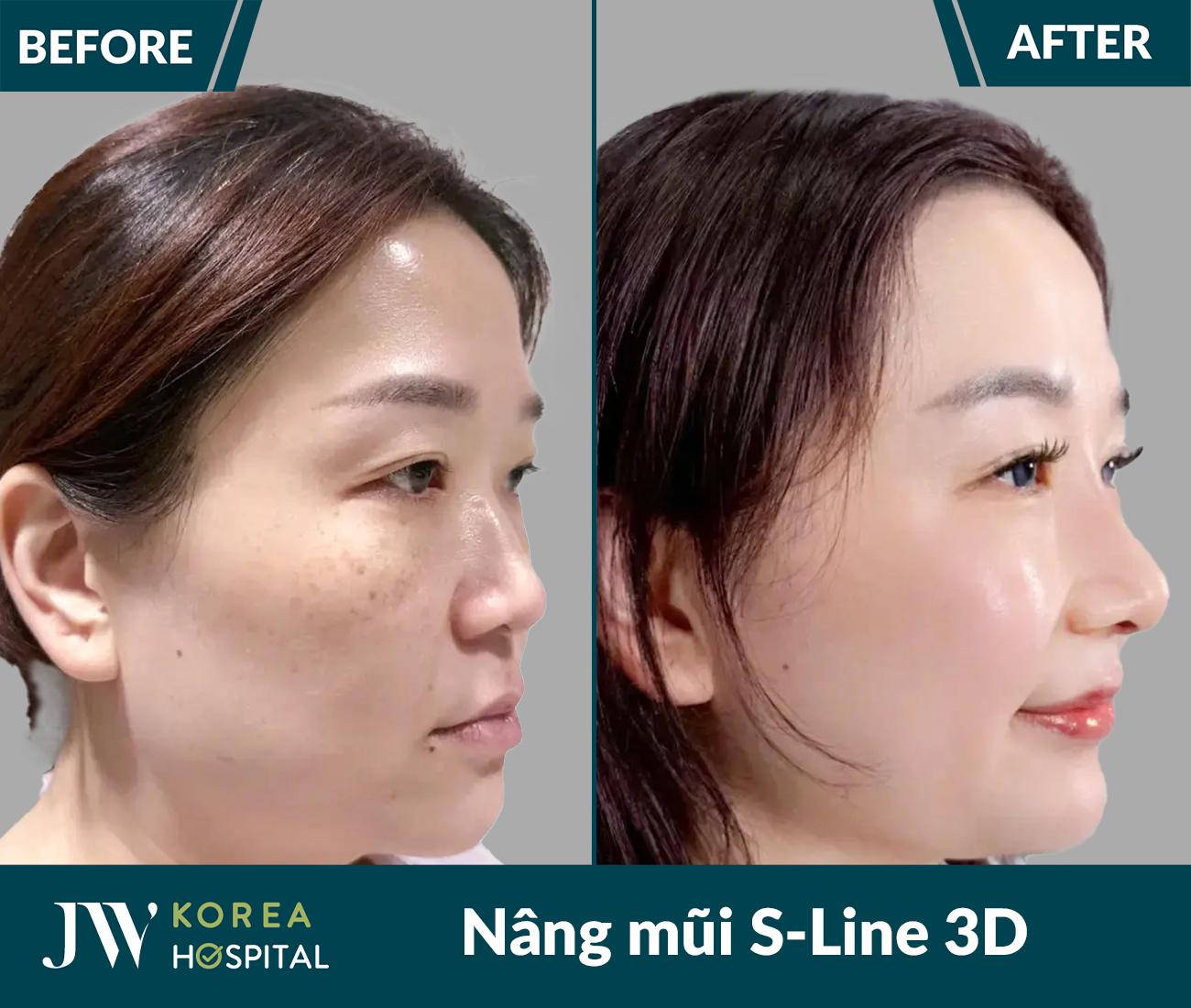 Nâng mũi S Line 3D