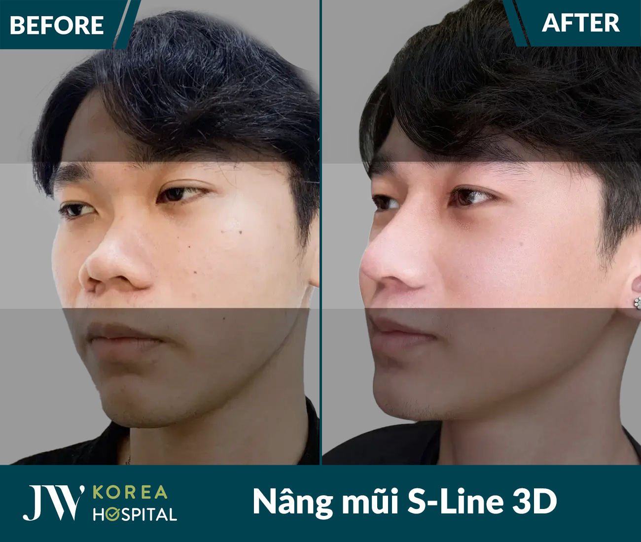 Nâng mũi S Line 3D