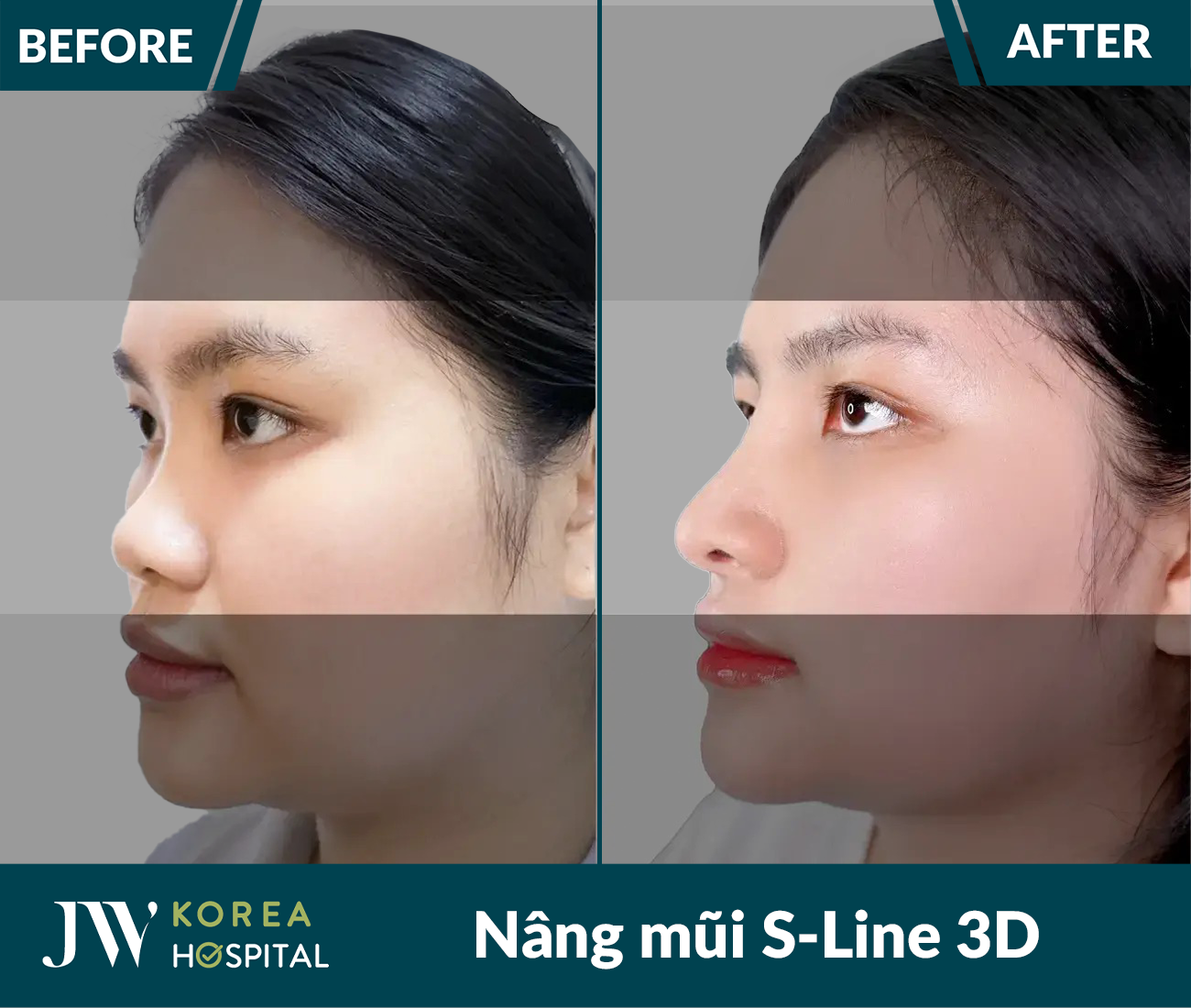 Nâng mũi S Line 3D