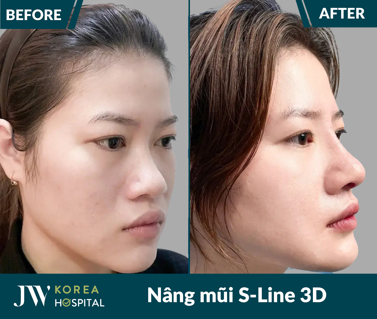 Nâng mũi S Line 3D