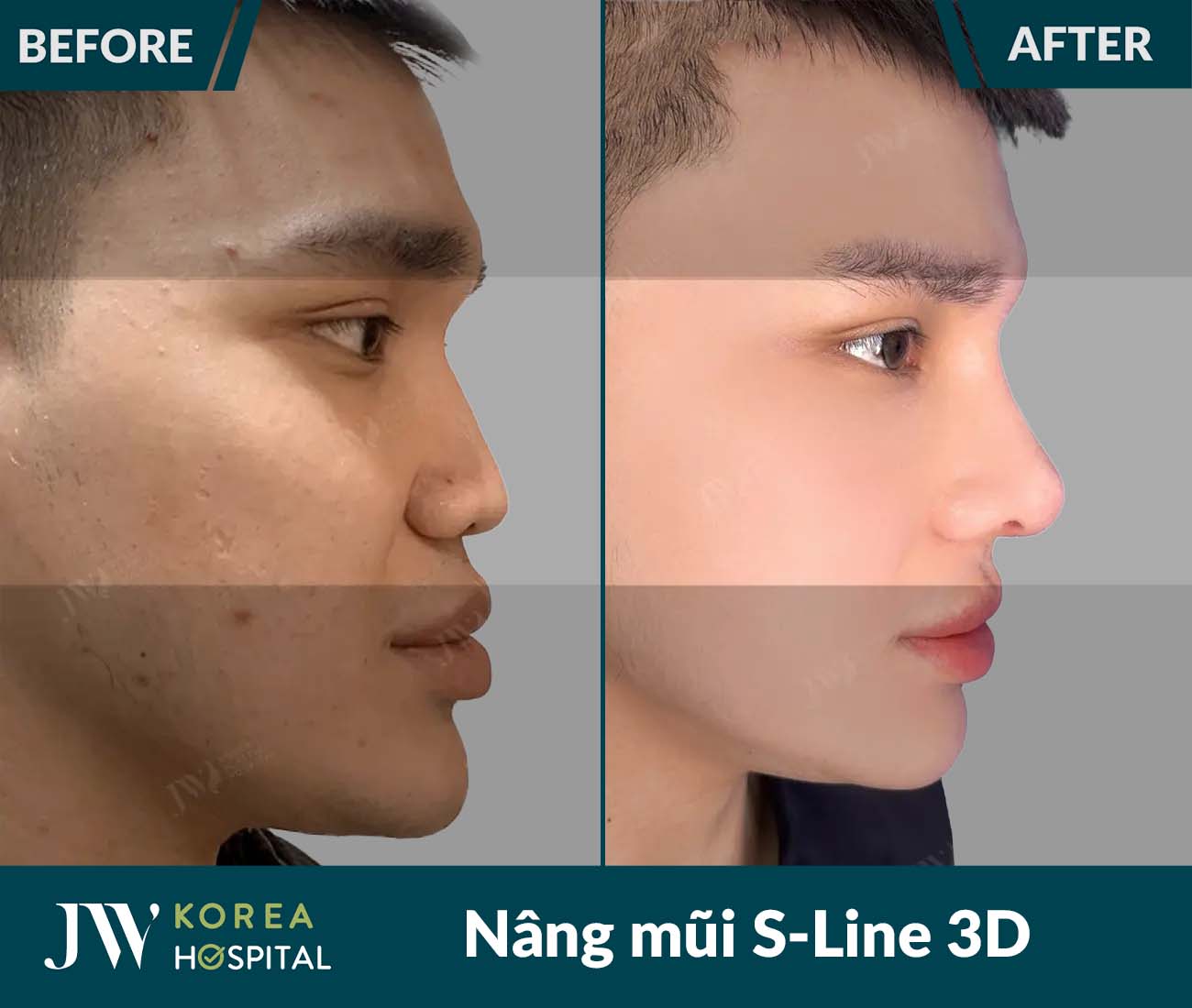 Nâng mũi S Line 3D