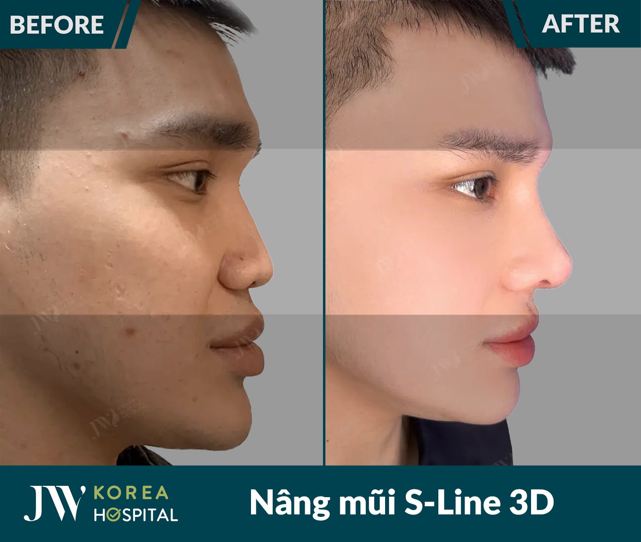 Nâng mũi S Line 3D