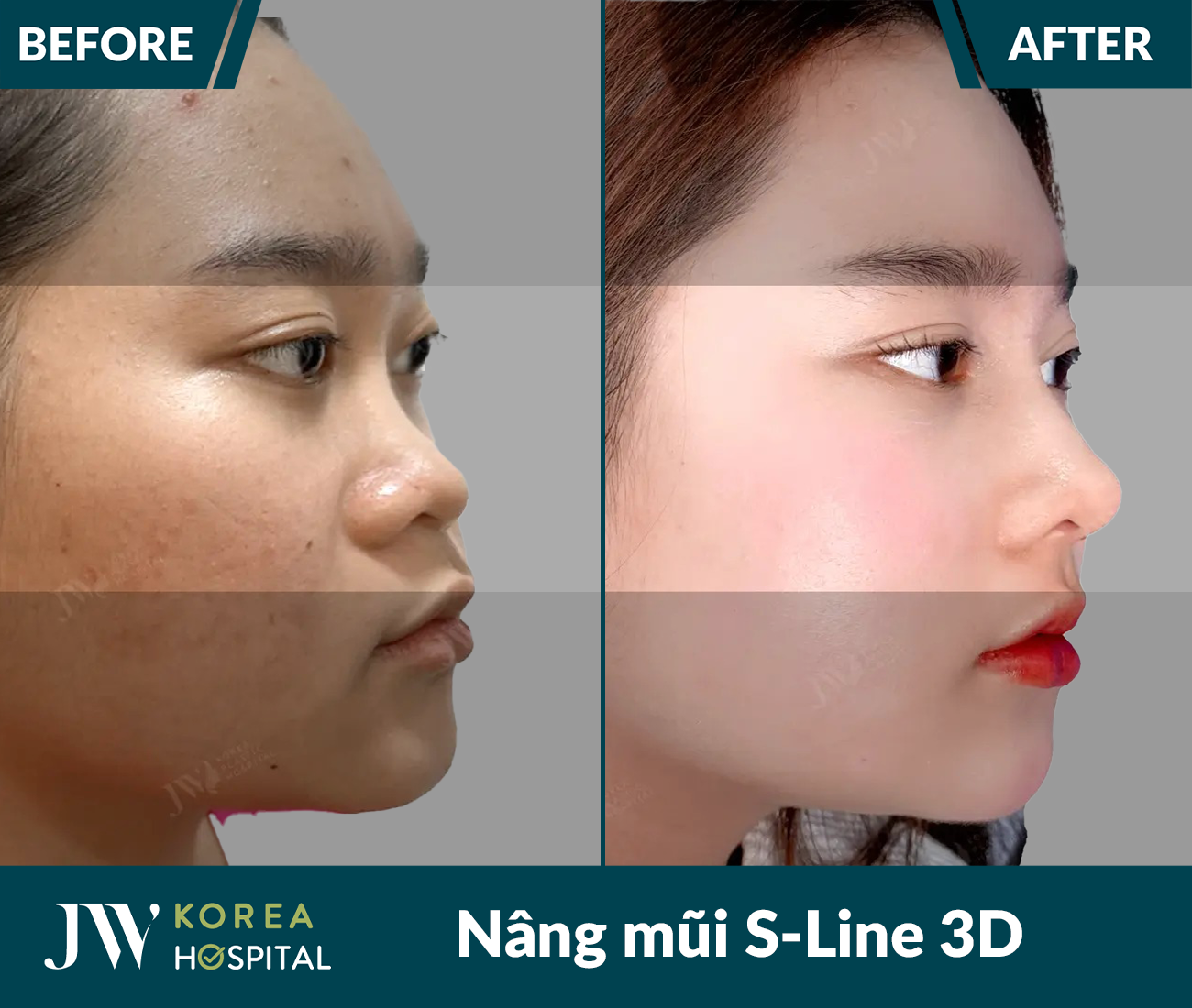 Nâng mũi S Line 3D