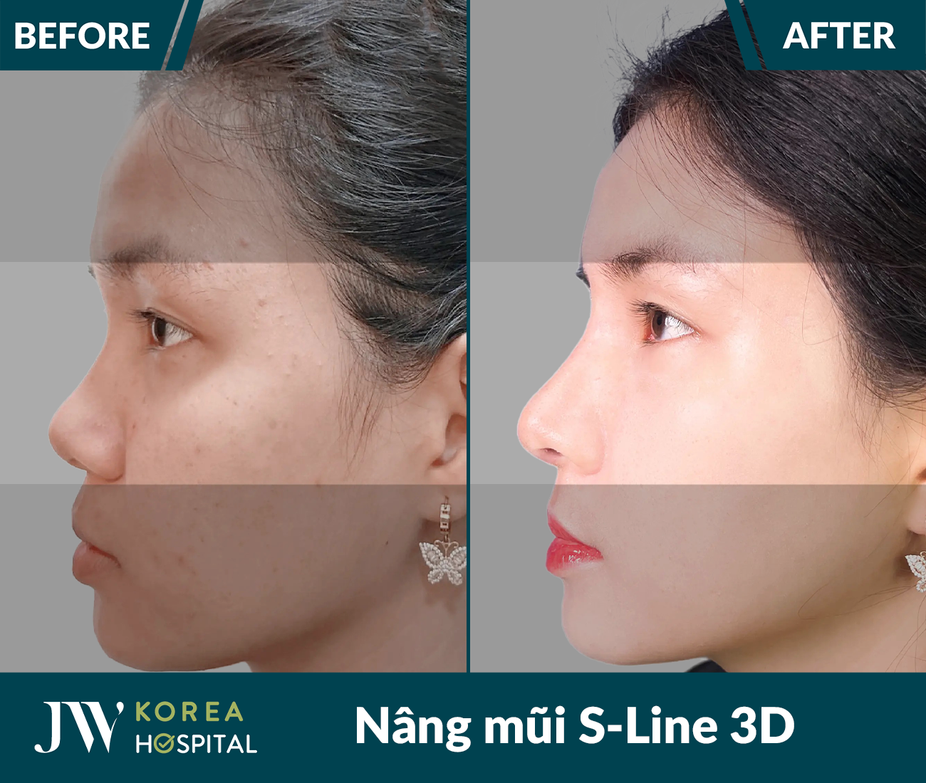Nâng mũi S Line 3D