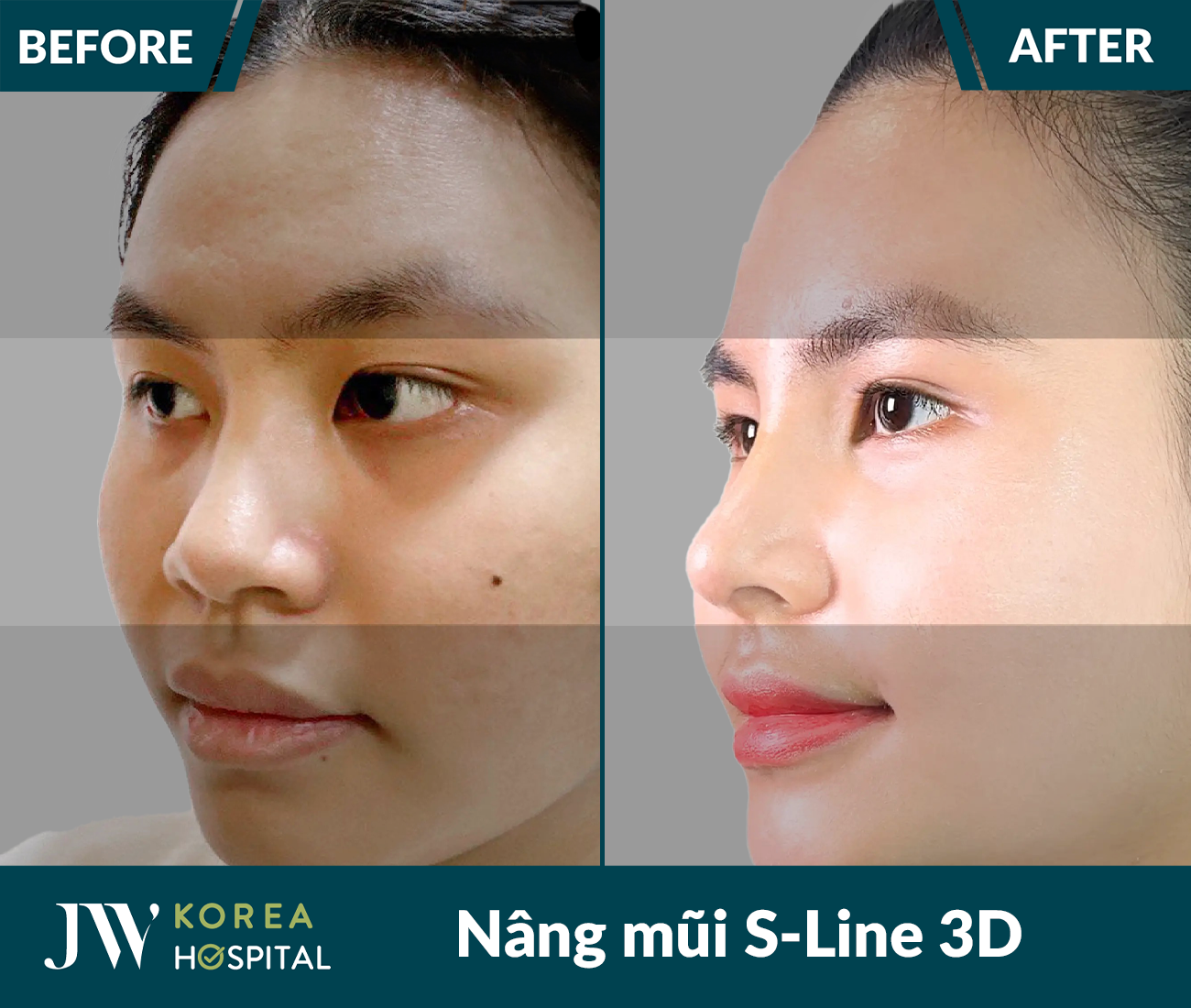 Nâng mũi S Line 3D