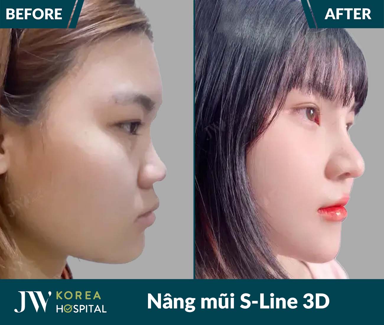 Nâng mũi S Line 3D