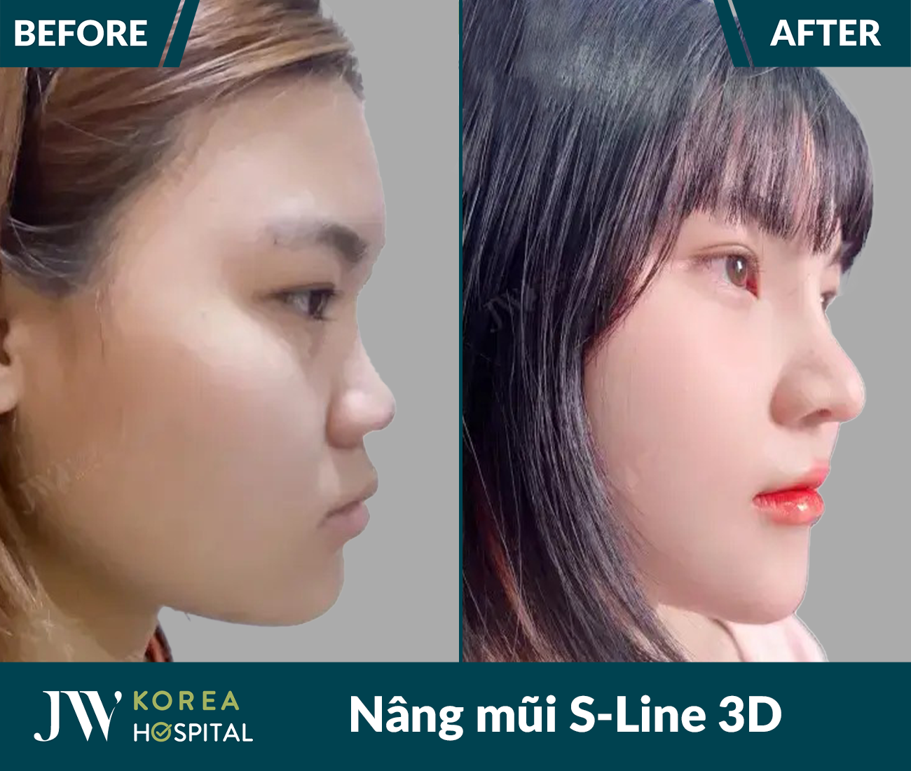 Nâng mũi S Line 3D