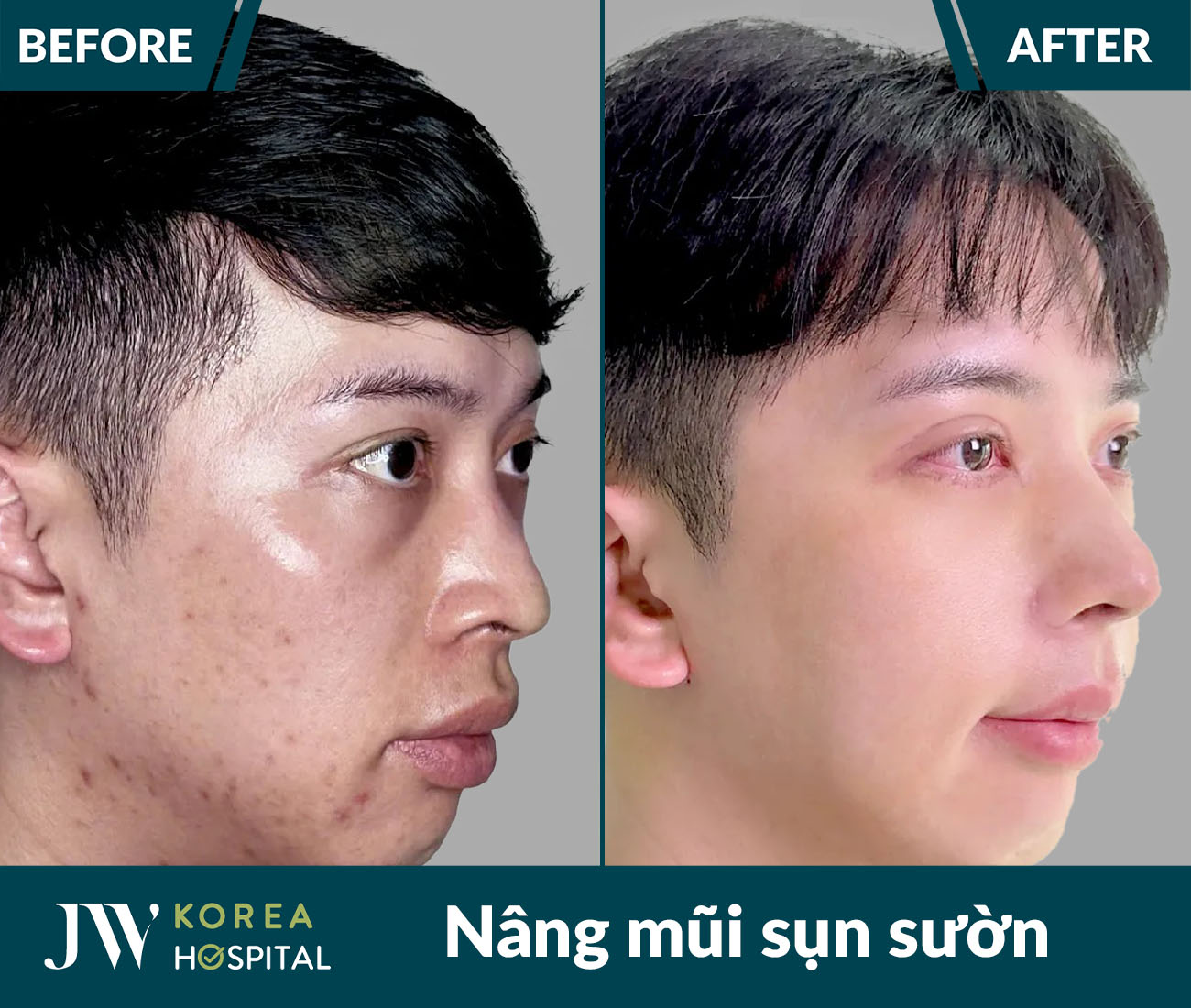 Nâng mũi sụn sườn