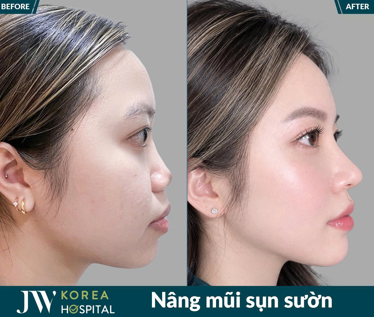 Nâng mũi sụn sườn