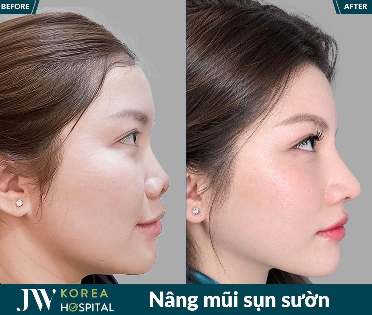 Nâng mũi sụn sườn