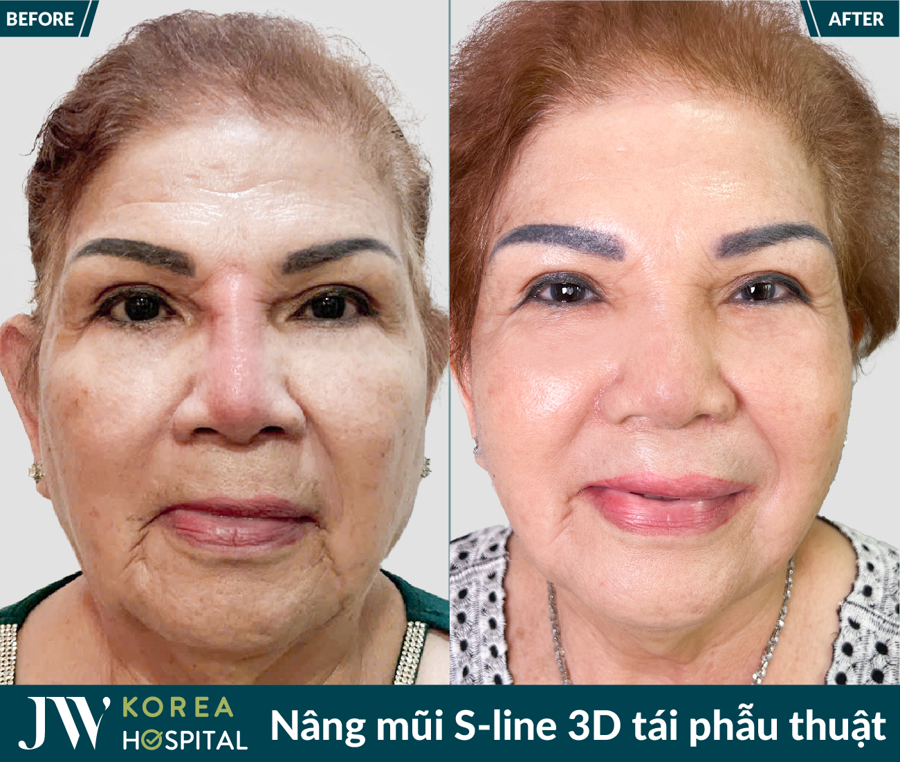 Tái phẫu thuật mũi lỗi