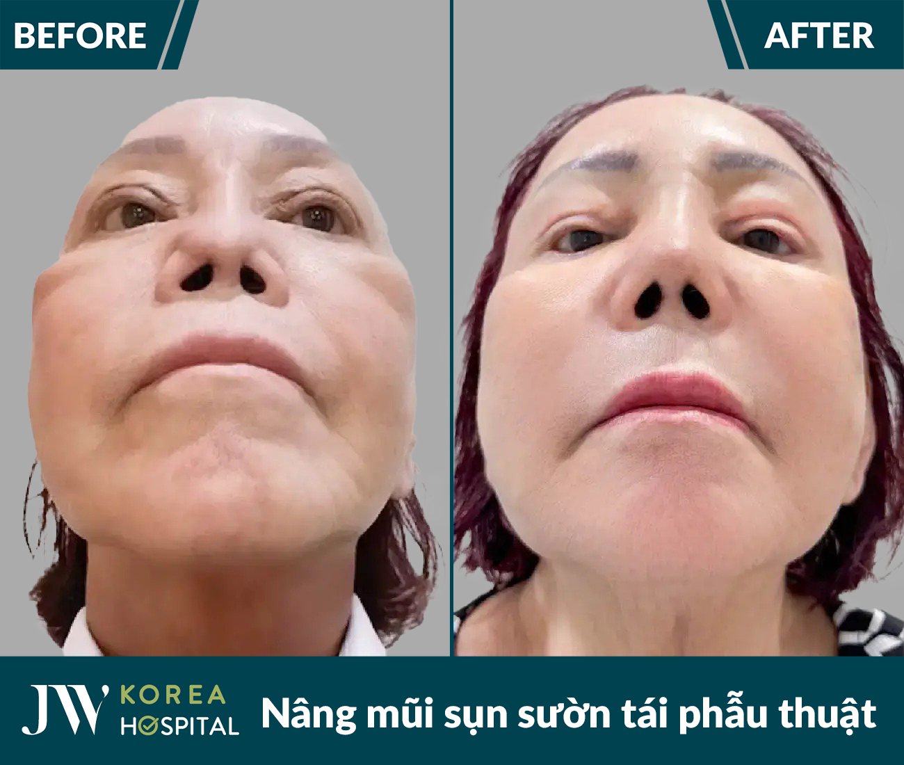 Tái phẫu thuật mũi lỗi