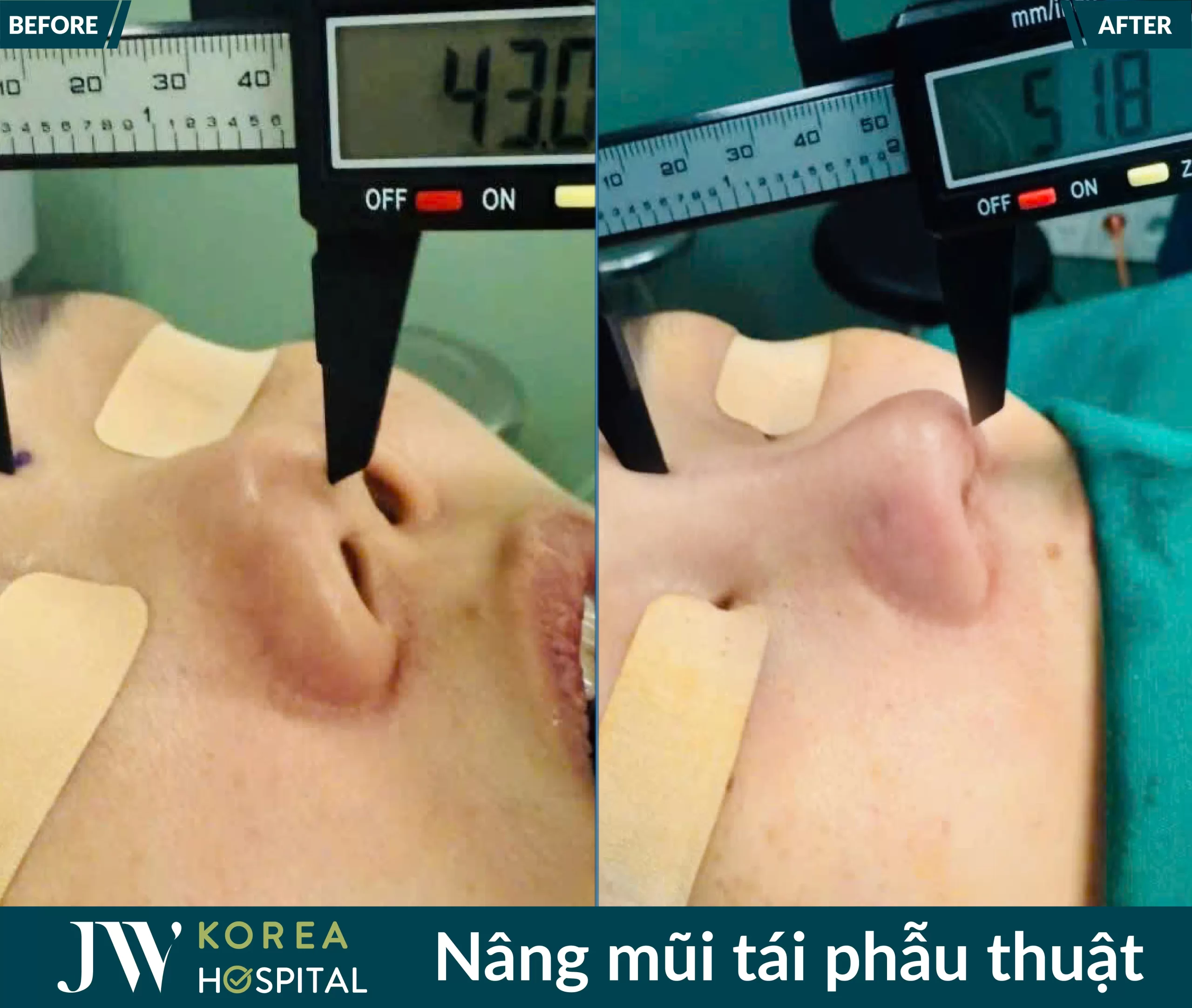 Tái phẫu thuật mũi lỗi