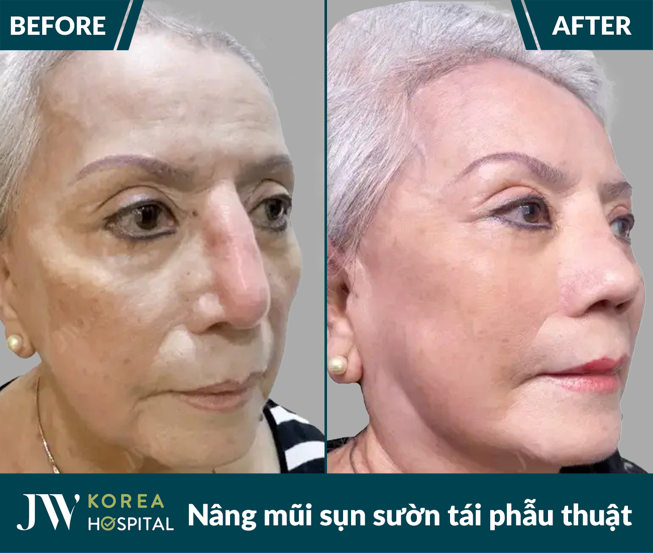 Tái phẫu thuật mũi lỗi