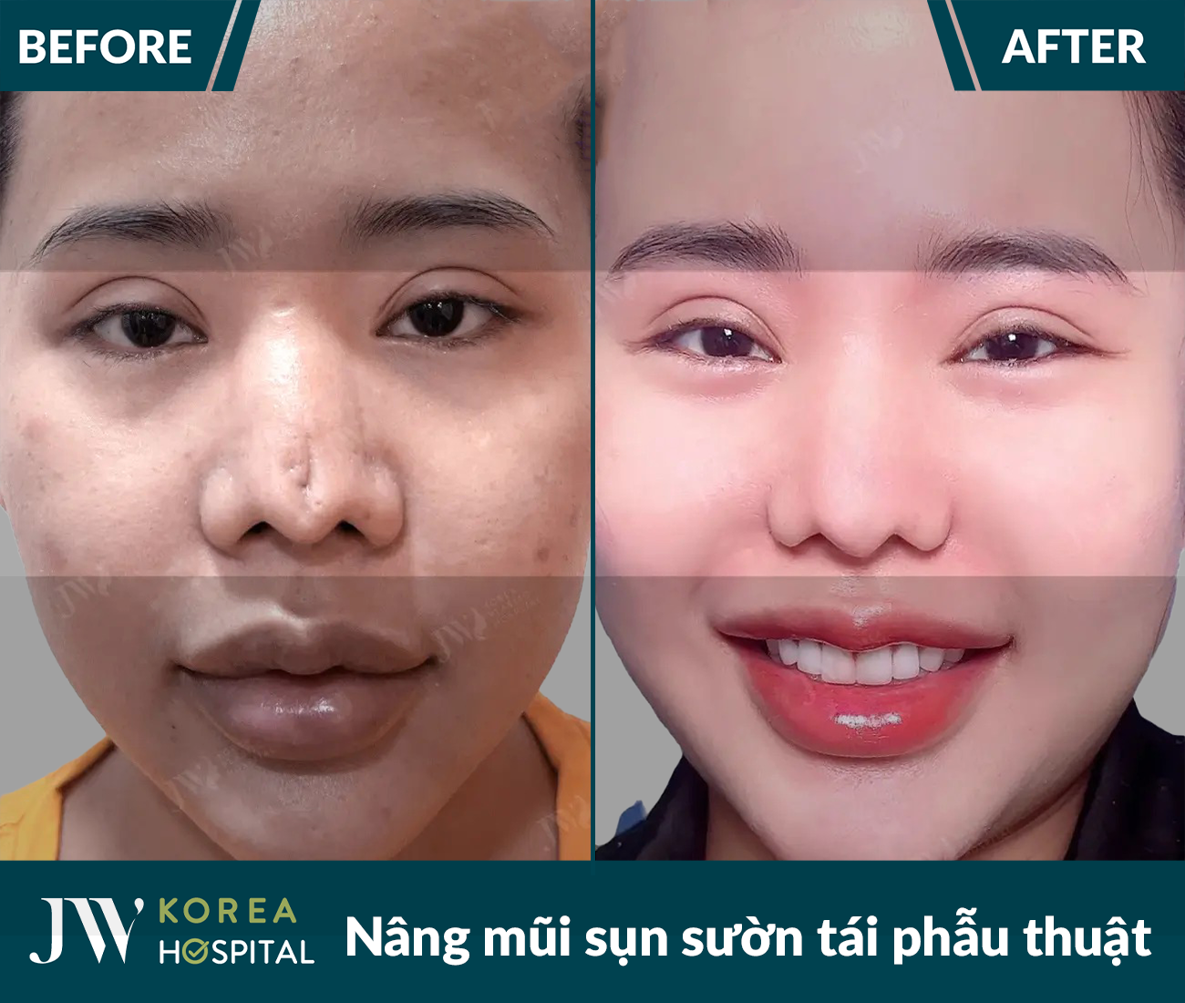 Tái phẫu thuật mũi lỗi