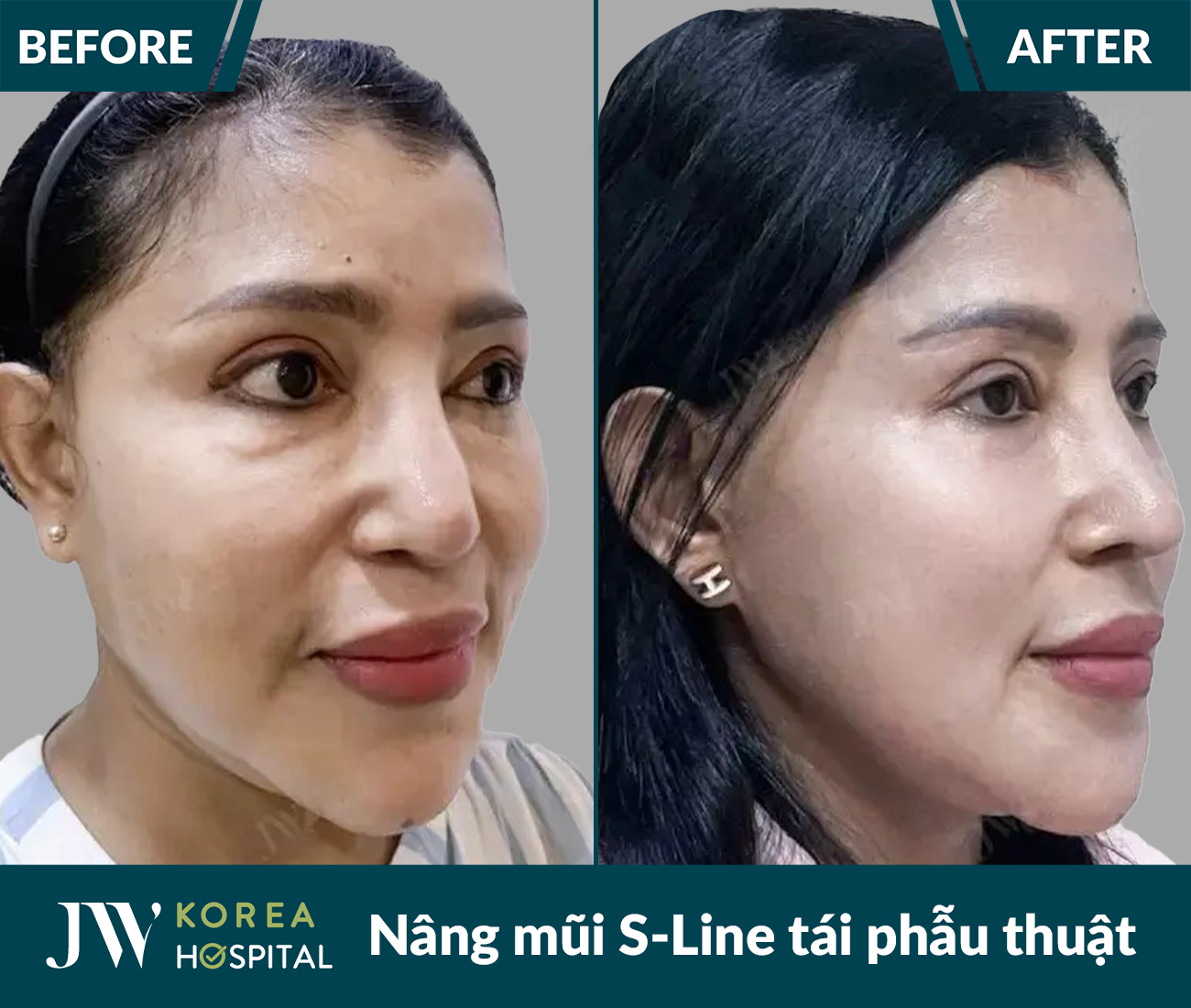 Tái phẫu thuật mũi lỗi