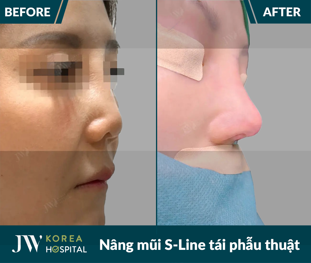 Tái phẫu thuật mũi lỗi