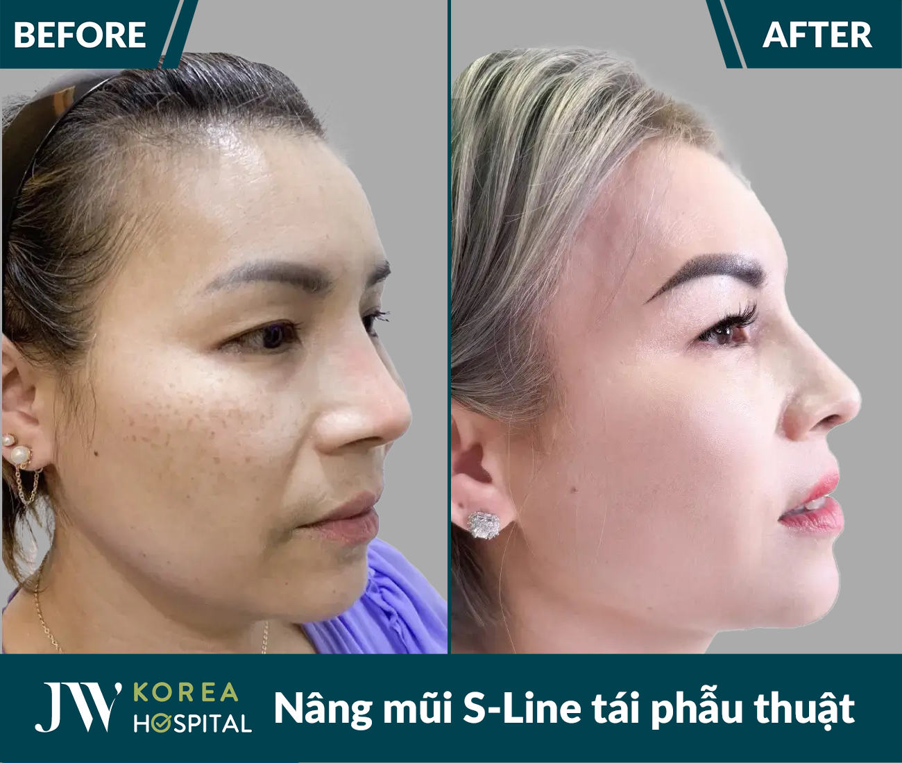 Tái phẫu thuật mũi lỗi