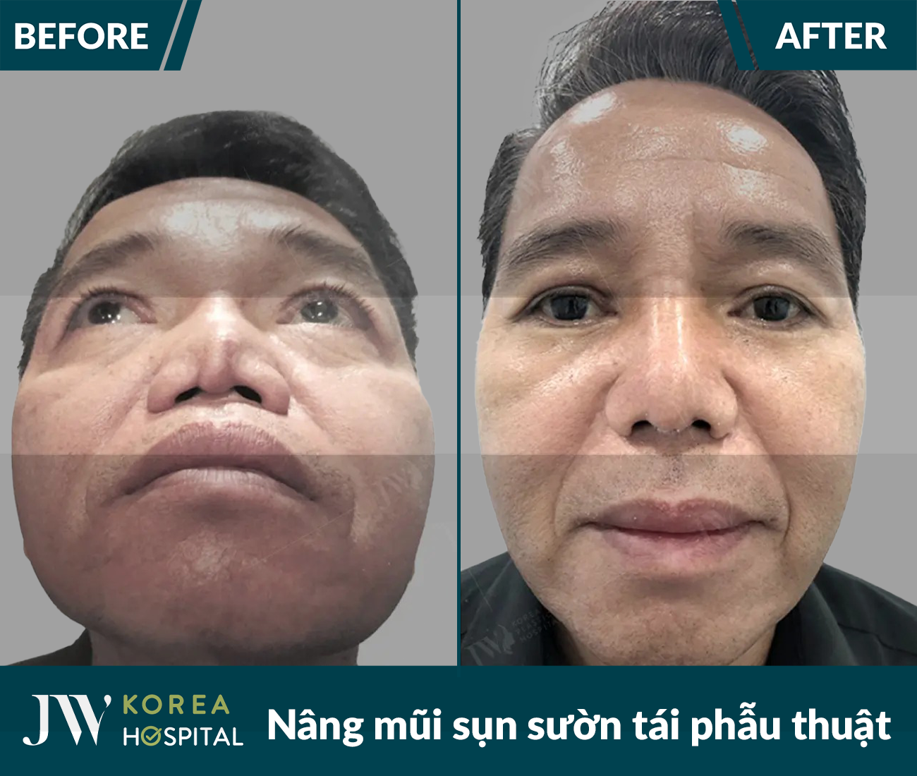 Tái phẫu thuật mũi lỗi