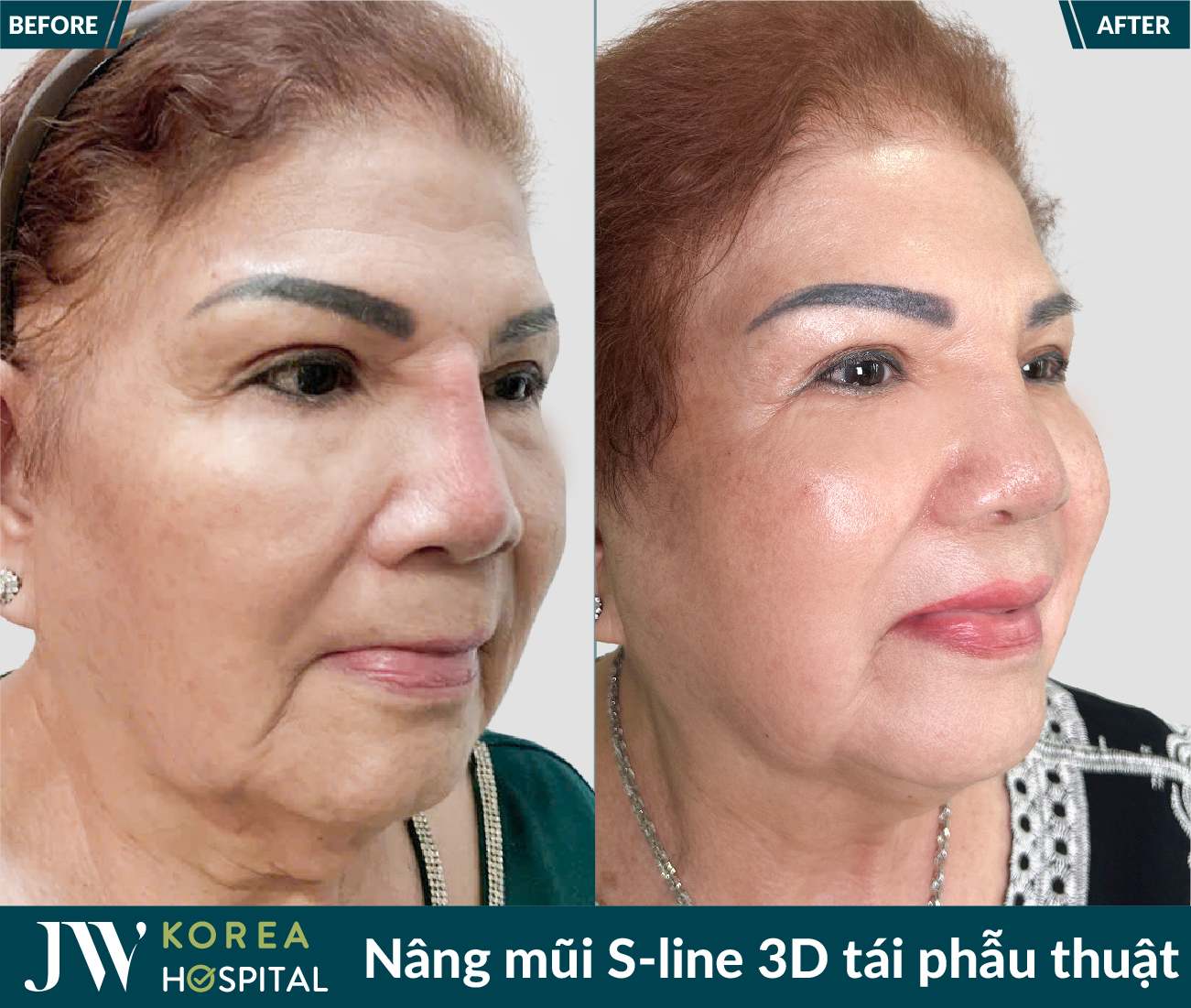 Tái phẫu thuật mũi lỗi