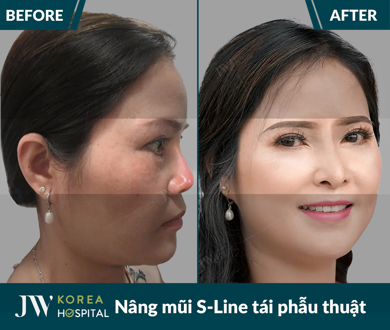 Tái phẫu thuật mũi lỗi