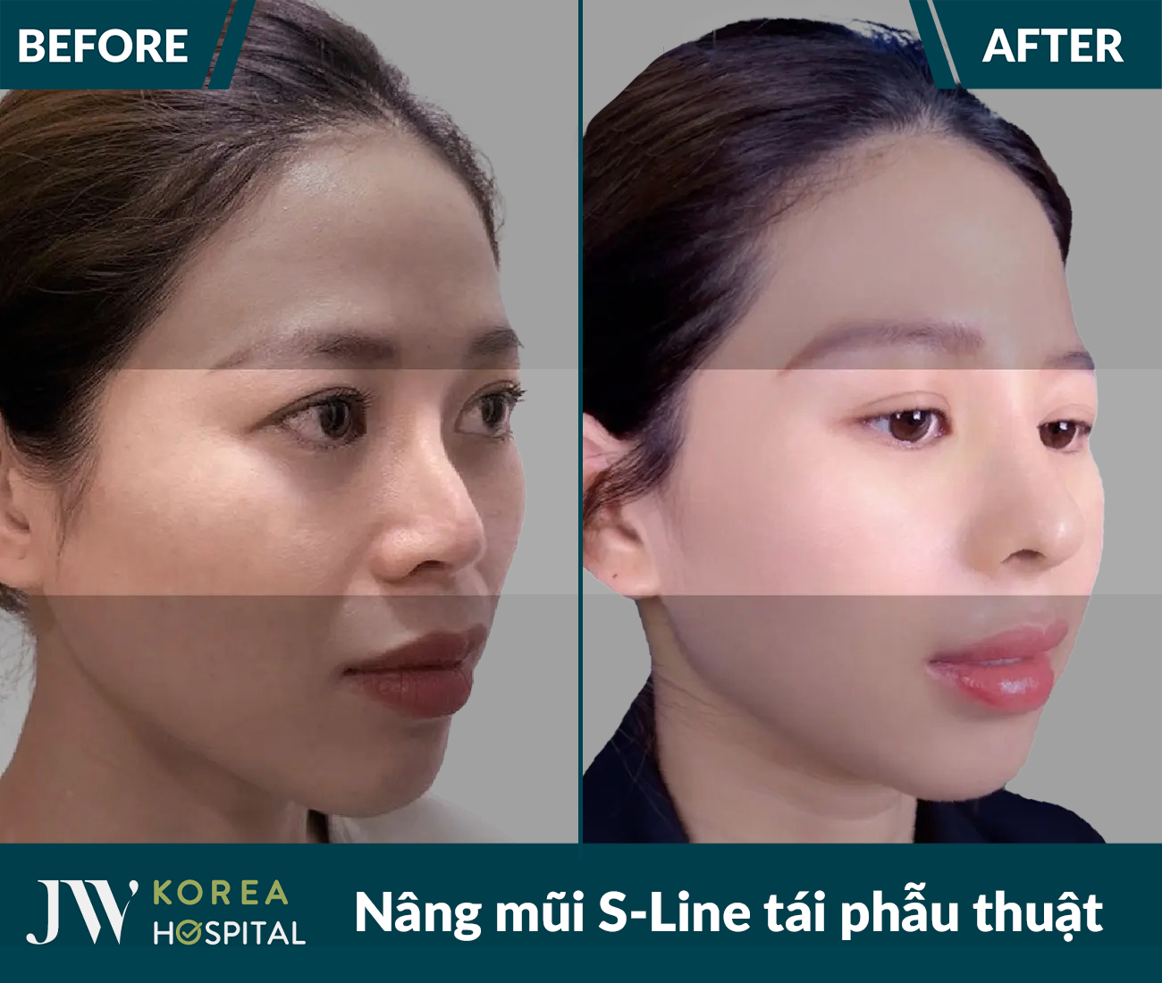Tái phẫu thuật mũi lỗi