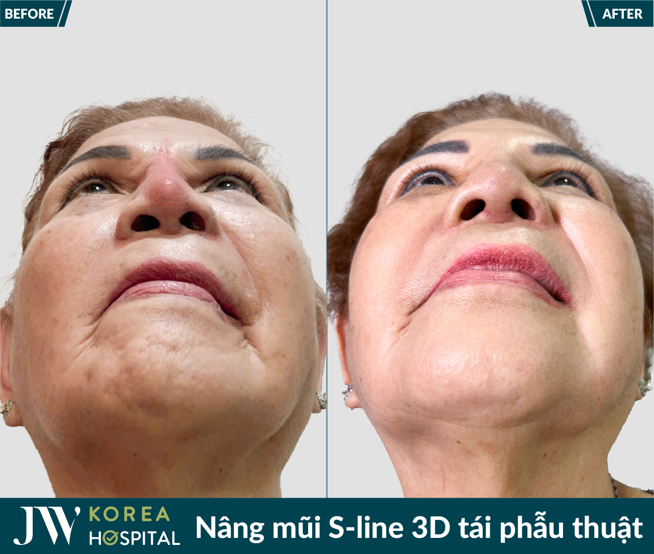 Tái phẫu thuật mũi lỗi