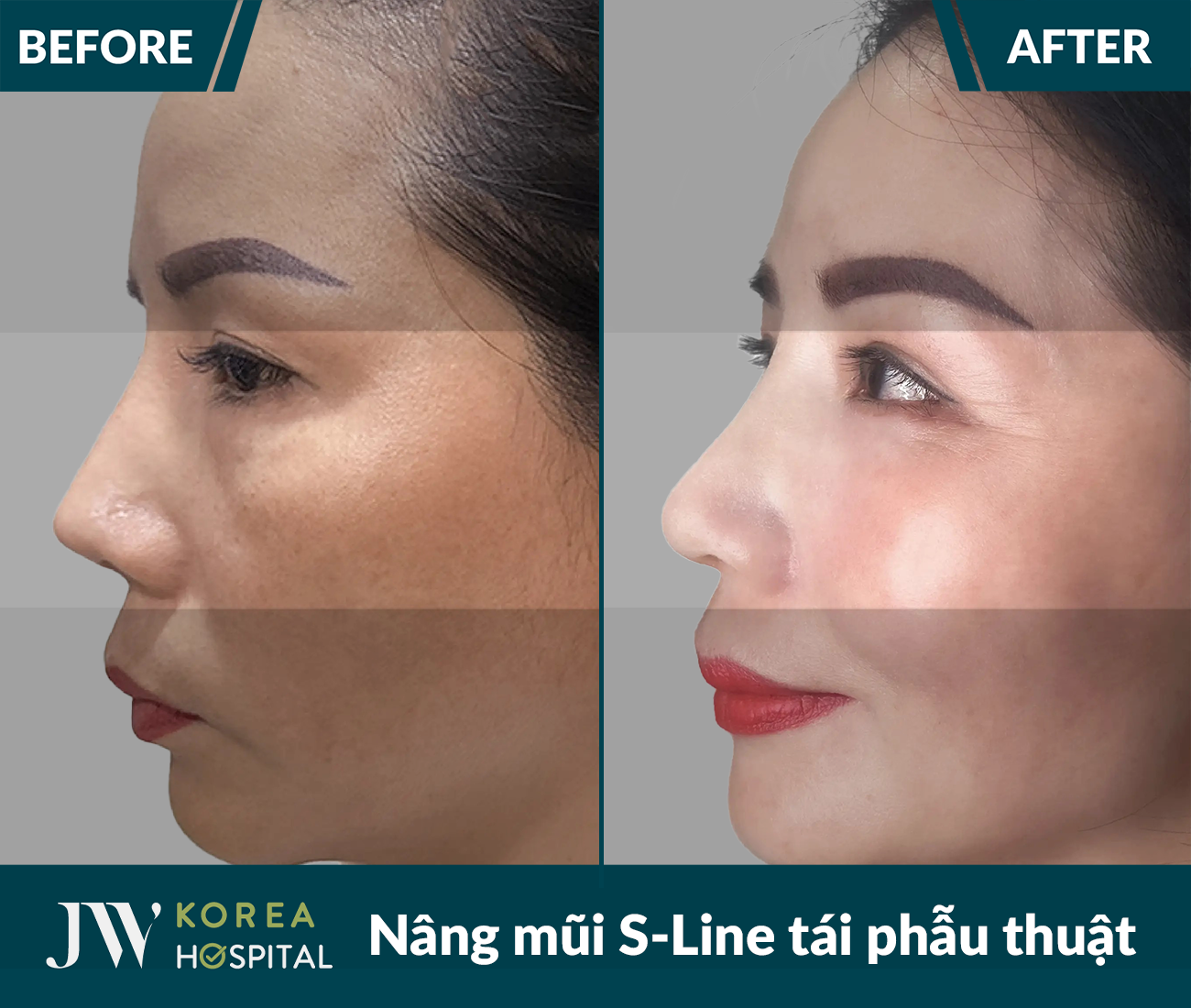 Tái phẫu thuật mũi lỗi