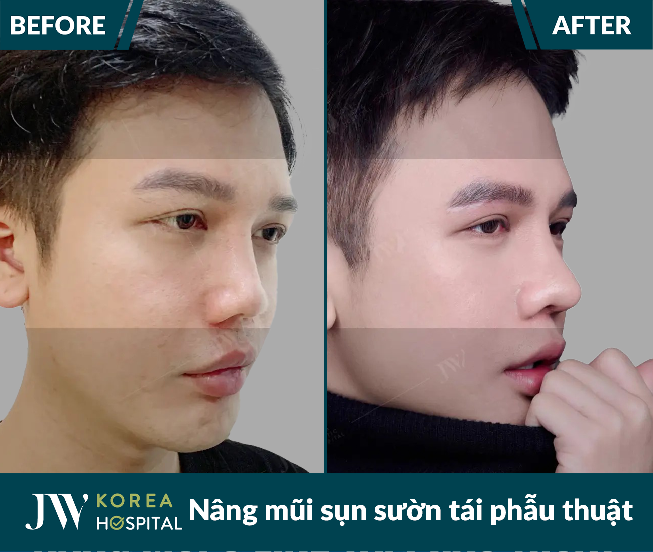 Tái phẫu thuật mũi lỗi