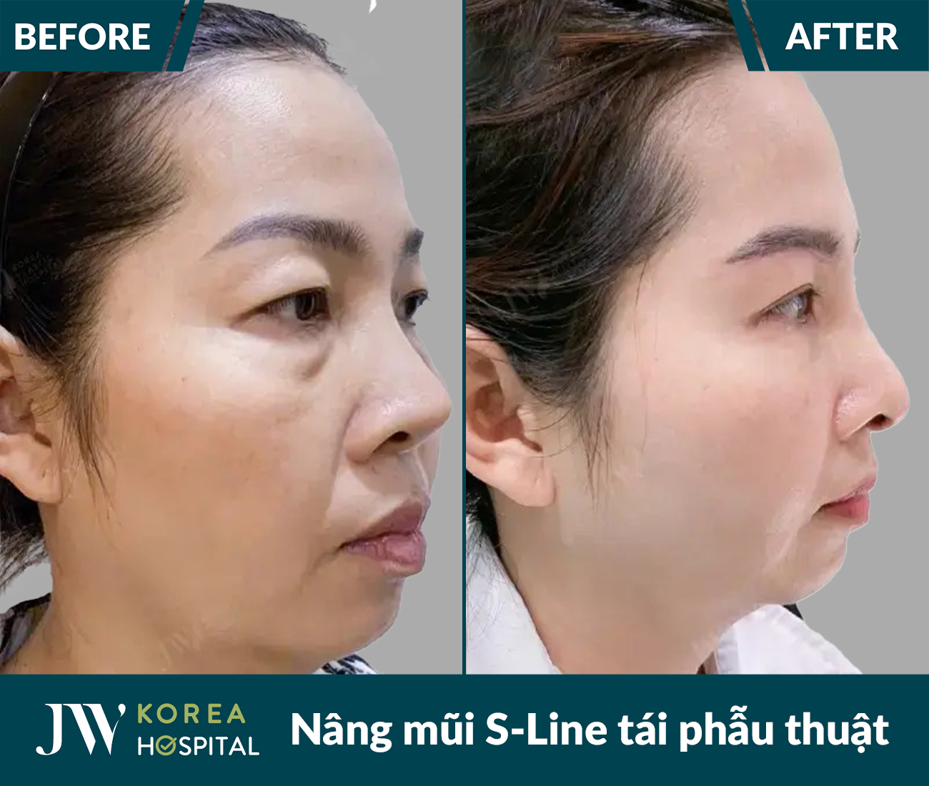 Tái phẫu thuật mũi lỗi